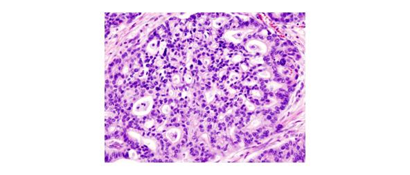 Figure 2 Pancreatic adenocarcinoma stain